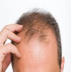 رابطه ریزش مو و تستوسترون