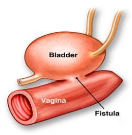 آنچه بايد درباره فيستول واژن بدانيد!