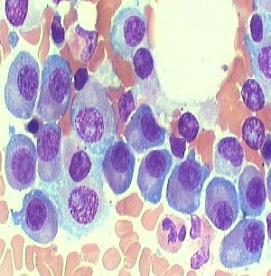 میلوم متعدد یا سرطان سلولهای پلاسما 