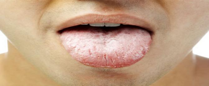 چه عاملی باعث سفید شدن زبان می گردد ؟