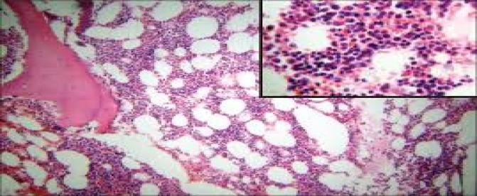 میلوم متعدد یا سرطان سلولهای پلاسما 