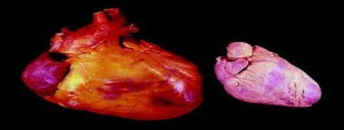 کاردیومگالی یا بزرگ شدگی قلب  چیست ؟