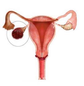 آنچه شما زنان بايد درباره تومورهاي تخمدان بدانيد!