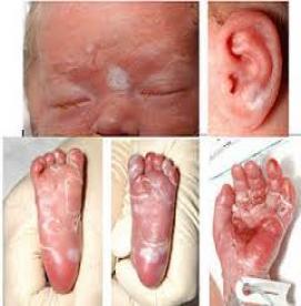 بیماریهای مقاربتی - سیفلیس مادرزادی